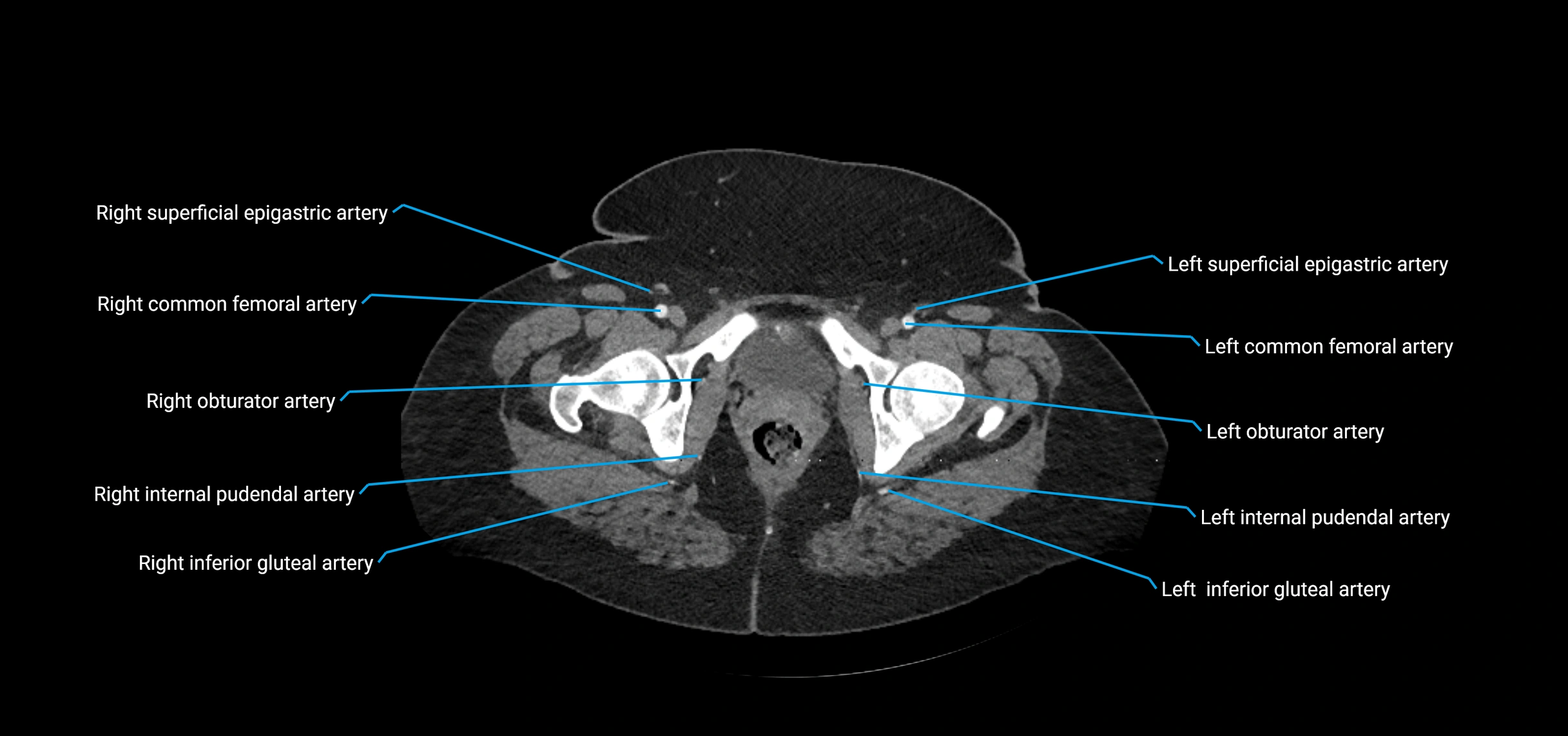 CTA abdomen axial cross sectional anatomy labelled image_254 (2).webp